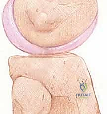 صورة توضيحية لـ إعادة بناء الزاوية الخلفية الوحشية للركبة: دليل شامل للمرضى مع الأستاذ الدكتور محمد هطيف