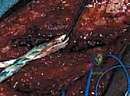 الآثار المدمرة للإصابات المركبة وفشل الرباط الصليبي