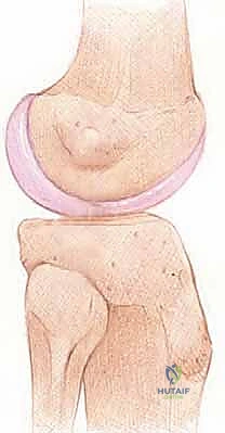 Illustration of management of posterolateral - Dr. Mohammed Hutaif