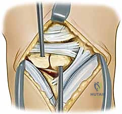 إدخال السلك الدليلي بدقة