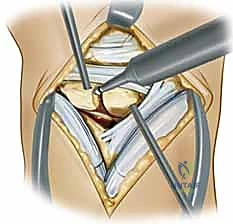 استخدام جهاز الحفر الدقيق