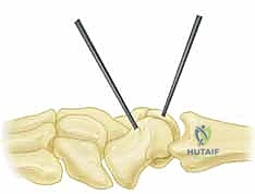 عملية RASL: حل متقدم لعدم استقرار الرسغ الزورقي الهلالي مع الأستاذ الدكتور محمد هطيف