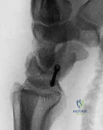RASL Procedure: Mastering Scapholunate Instability Correction