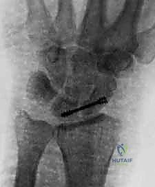 صورة توضيحية لـ عملية RASL: حل متقدم لعدم استقرار الرسغ الزورقي الهلالي مع الأستاذ الدكتور محمد هطيف