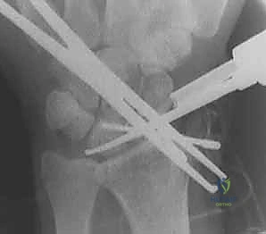 صورة توضيحية لـ عملية RASL: حل متقدم لعدم استقرار الرسغ الزورقي الهلالي مع الأستاذ الدكتور محمد هطيف