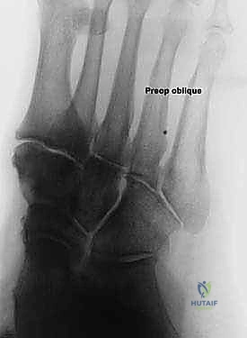 جراحة إطالة العمود الجانبي للقدم في صنعاء