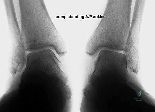 تقييم حالة القدم المسطحة المكتسبة