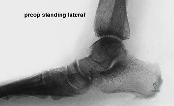 تشريح القدم وميكانيكا الحركة