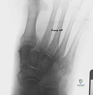 إطالة العمود الجانبي للقدم: حل جراحي متقدم لتشوه القدم المسطحة المكتسبة مع الأستاذ الدكتور محمد هطيف