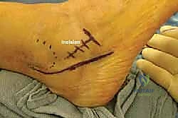 تآكل الأوتار وضعف الأربطة