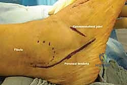 صورة طبية: إطالة العمود الجانبي للقدم: حل جراحي متقدم لتشوه القدم المسطحة المكتسبة مع الأستاذ الدكتور محمد هطيف