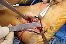 الألم الموضعي في الكاحل والقدم