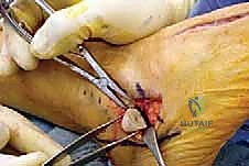 صورة طبية: إطالة العمود الجانبي للقدم: حل جراحي متقدم لتشوه القدم المسطحة المكتسبة مع الأستاذ الدكتور محمد هطيف