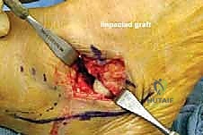 صورة طبية: إطالة العمود الجانبي للقدم: حل جراحي متقدم لتشوه القدم المسطحة المكتسبة مع الأستاذ الدكتور محمد هطيف