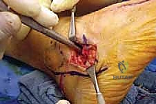 صورة طبية: إطالة العمود الجانبي للقدم: حل جراحي متقدم لتشوه القدم المسطحة المكتسبة مع الأستاذ الدكتور محمد هطيف