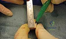 صورة طبية: إطالة العمود الجانبي للقدم: حل جراحي متقدم لتشوه القدم المسطحة المكتسبة مع الأستاذ الدكتور محمد هطيف