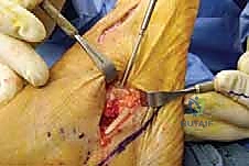 صورة طبية: إطالة العمود الجانبي للقدم: حل جراحي متقدم لتشوه القدم المسطحة المكتسبة مع الأستاذ الدكتور محمد هطيف