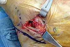 صورة طبية: إطالة العمود الجانبي للقدم: حل جراحي متقدم لتشوه القدم المسطحة المكتسبة مع الأستاذ الدكتور محمد هطيف