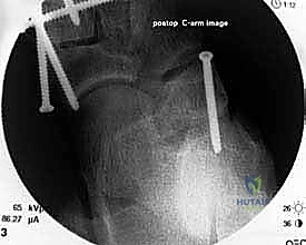صورة طبية: إطالة العمود الجانبي للقدم: حل جراحي متقدم لتشوه القدم المسطحة المكتسبة مع الأستاذ الدكتور محمد هطيف