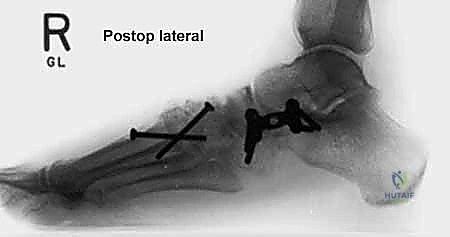 صورة طبية: إطالة العمود الجانبي للقدم: حل جراحي متقدم لتشوه القدم المسطحة المكتسبة مع الأستاذ الدكتور محمد هطيف