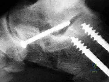 صورة توضيحية لـ إطالة العمود الجانبي للقدم: حل جراحي متقدم لتشوه القدم المسطحة المكتسبة مع الأستاذ الدكتور محمد هطيف