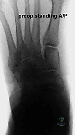 صعوبة المشي والوقوف لفترات طويلة