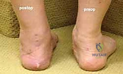 صورة طبية: إطالة العمود الجانبي للقدم: حل جراحي متقدم لتشوه القدم المسطحة المكتسبة مع الأستاذ الدكتور محمد هطيف