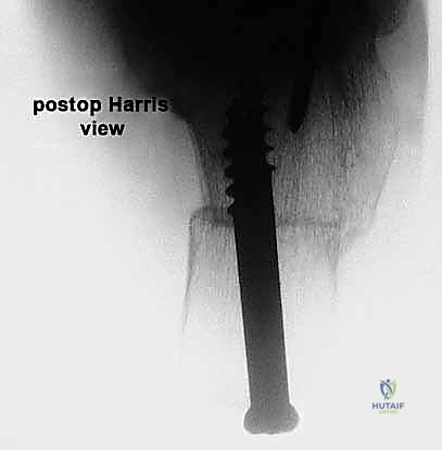 Lateral Column Lengthening: An Intraoperative Masterclass for Acquired Flatfoot Deformity