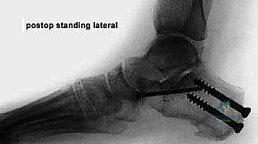 صورة طبية: إطالة العمود الجانبي للقدم: حل جراحي متقدم لتشوه القدم المسطحة المكتسبة مع الأستاذ الدكتور محمد هطيف