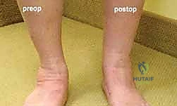 صورة طبية: إطالة العمود الجانبي للقدم: حل جراحي متقدم لتشوه القدم المسطحة المكتسبة مع الأستاذ الدكتور محمد هطيف