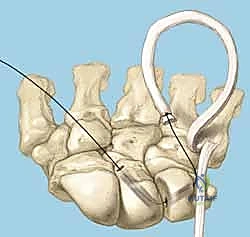 Intraoperative Surgical Step