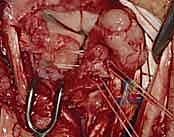 Surgical technique step for Lunotriquetral Ligament Repair and Augmentation
