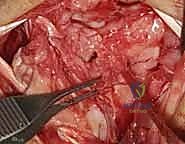 Lunotriquetral Ligament Repair and Augmentation: An Intraoperative Masterclass