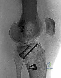 Illustration of multiple ligamentinjured knee - Dr. Mohammed Hutaif