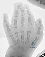 التحضير قبل جراحة فصل الأصابع