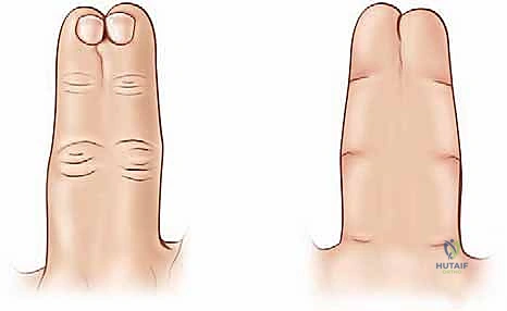 الفصل الدقيق للأنسجة والأعصاب