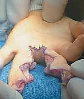 جراحة فصل الأصابع الملتصقة البسيطة: دليل شامل للمرضى في صنعاء