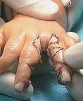 التشريح الدقيق لليد والأصابع الملتصقة