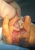 جراحة فصل الأصابع الملتصقة البسيطة: دليل شامل للمرضى في صنعاء