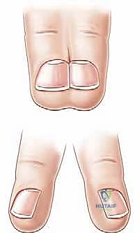 تخطيط الشقوق الجراحية المتعرجة