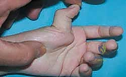 صورة طبية: تصحيح تشوه الإبهام الراحي: دليل شامل للمرضى مع الأستاذ الدكتور محمد هطيف في صنعاء