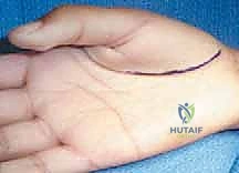 صورة توضيحية لـ تصحيح تشوه الإبهام الراحي: دليل شامل للمرضى مع الأستاذ الدكتور محمد هطيف في صنعاء