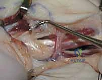 Illustration of first dorsal interosseous - Dr. Mohammed Hutaif