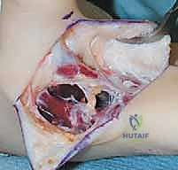 صورة توضح التشنج العضلي في اليد