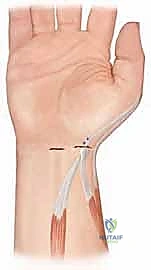 تصحيح تشوه الإبهام الراحي: دليل شامل للمرضى مع الأستاذ الدكتور محمد هطيف في صنعاء