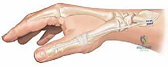 صورة توضيحية لـ تصحيح تشوه الإبهام الراحي: دليل شامل للمرضى مع الأستاذ الدكتور محمد هطيف في صنعاء