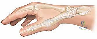 صورة توضيحية لـ تصحيح تشوه الإبهام الراحي: دليل شامل للمرضى مع الأستاذ الدكتور محمد هطيف في صنعاء