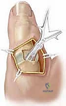 Intraoperative Surgical Step