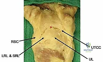 Mastering Perilunate & Lunate Dislocation Repair: An Intraoperative Guide to Greater and Lesser Arc Injuries