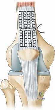 تقنية خياطة وتر الرضفة وتمرير الخيوط